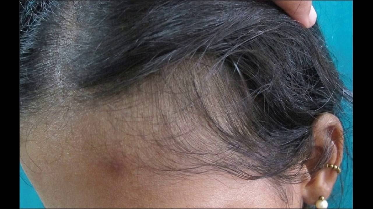 Самые распространенные причины выпадения волос у девушек
