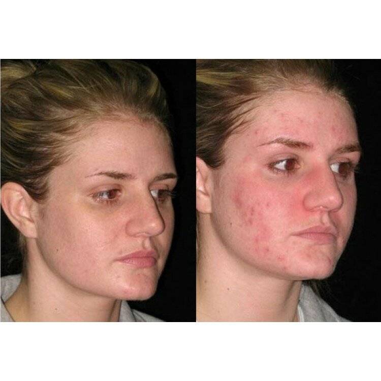 Чистка лица у косметолога (в салоне): фото до и после процедуры, виды, описание, отличия, зачем нужна, сколько времени занимает