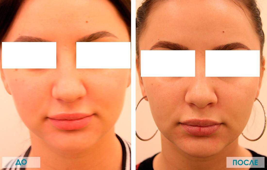 Комки биша: удаление, последствия, фото звезд до и после + видео