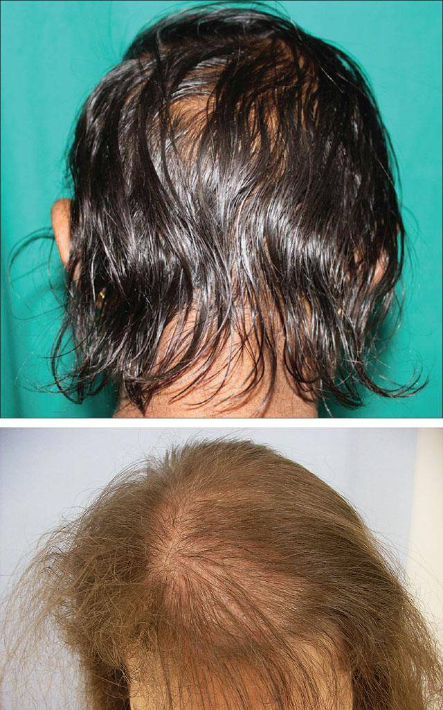 Сильное выпадение волос у женщин: причины и лечение