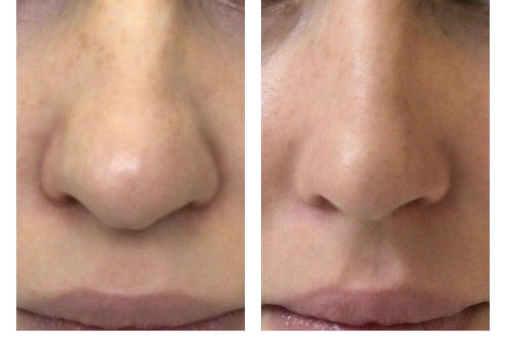 Липолитики для лица: отзывы косметологов, фото до и после, лучшие препараты — дермахил, мезофарм и тп, показания — уменьшение носа, от мешков под глазами, жировых отложений и др