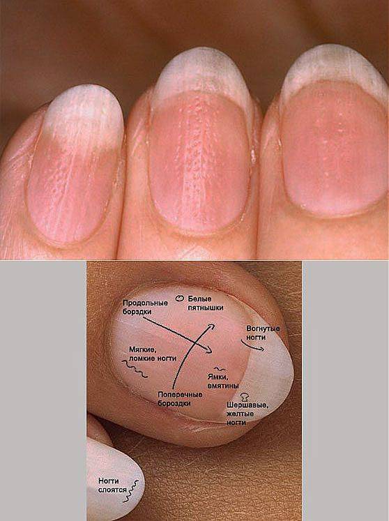 О чем говорит заболевание ногтей. Заболевания по состоянию ногтей. Изменение ногтевой пластины. Выявление болезни по ногтям.