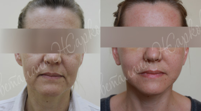 Процедура для лица после 60. Круговая пластика лица. Брыли до и после фейслифтинга. Косметические процедуры для лица после 60 лет.