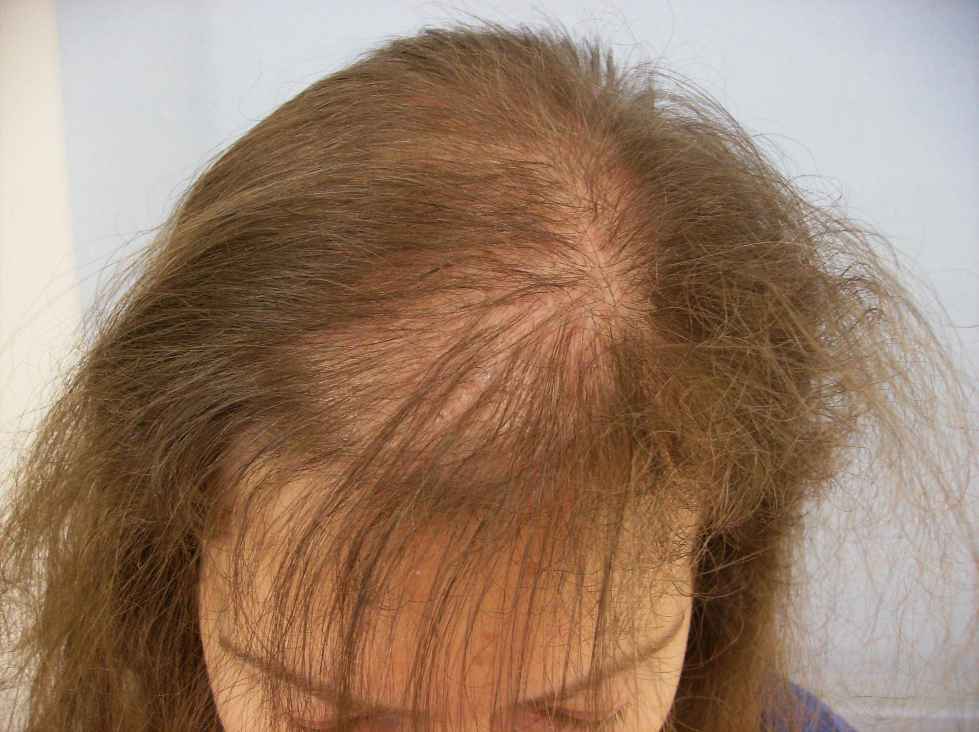 10 причин выпадения волос у женщин
