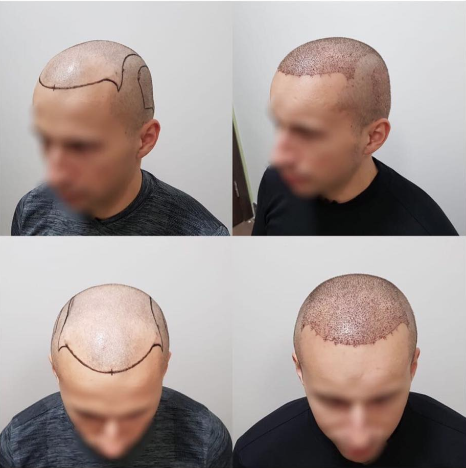 Пересадка волос в новосибирске. Трансплантация волос на голове. Прически с лысиной на затылке.