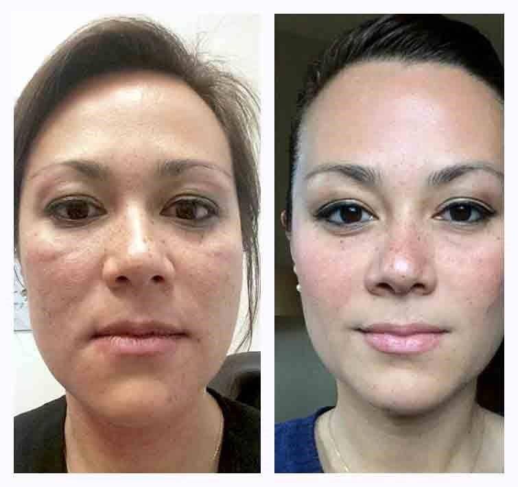 Жидкие нити для подтяжки лица в косметологии