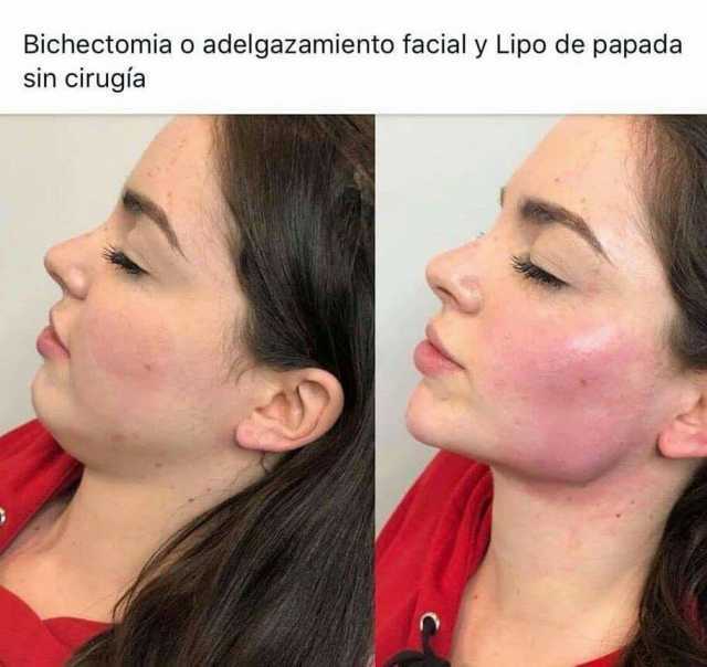 Липолитики для лица - прямые и непрямые препараты, результаты похудения с фото