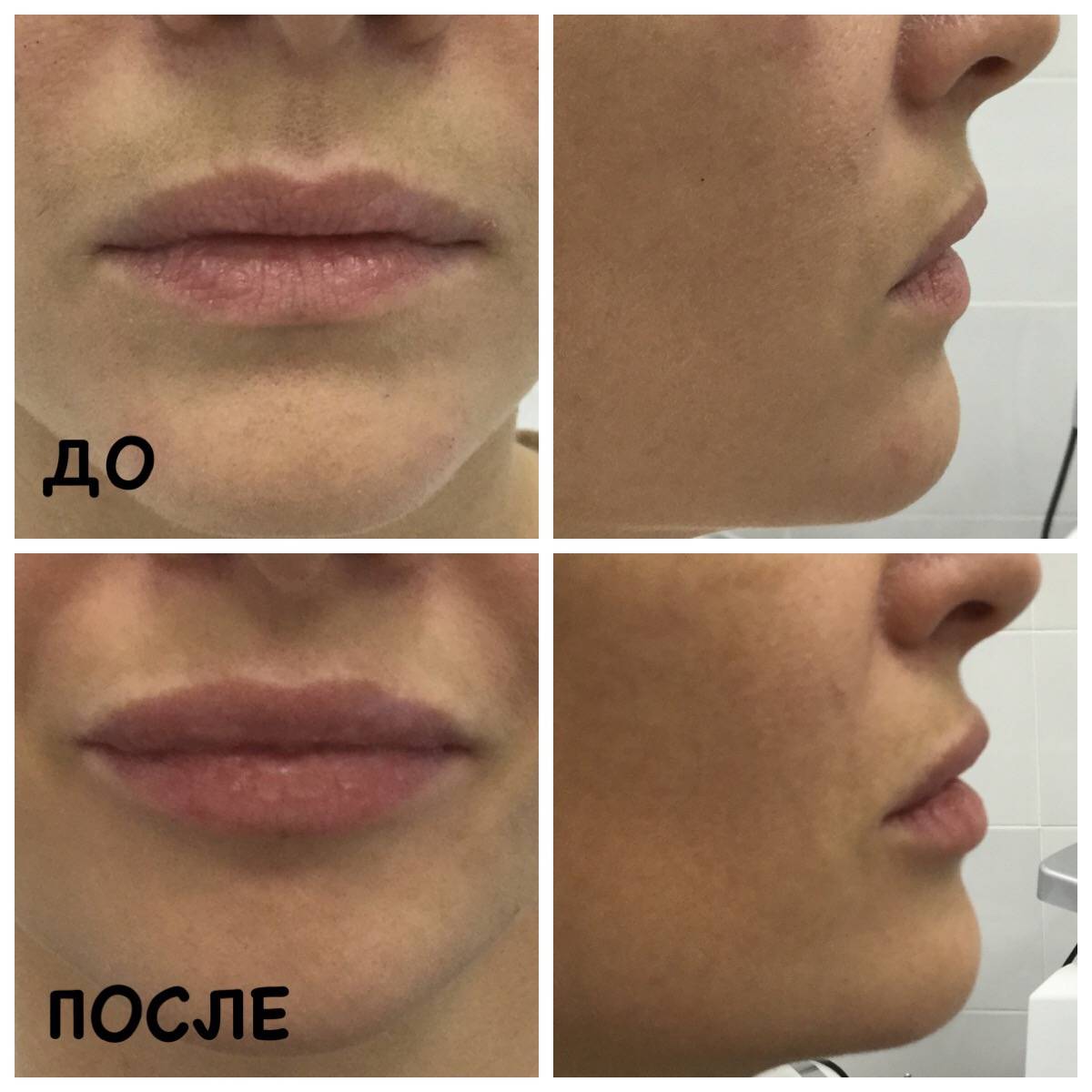Поднять уголки губ гиалуроновой кислотой фото до и после