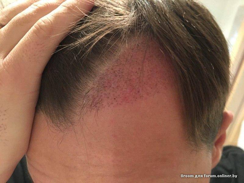 Пересадка яичек