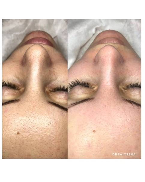 В чем эффективность комбинированной чистки лица, что это такое и кому подойдет