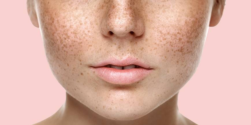 Проверенные способы борьбы с солнечной пигментацией на коже