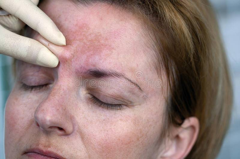 Бывает ли аллергия на ботокс: причины и побочные действия