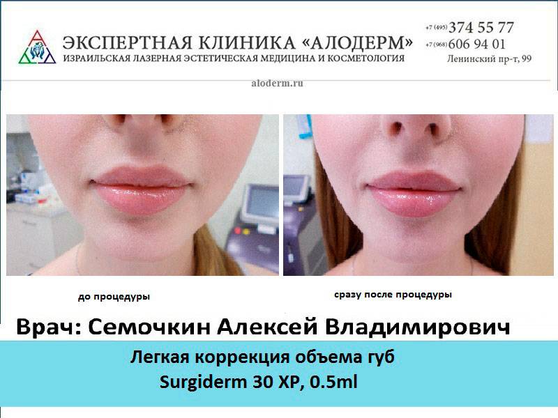 Увеличение губ гиалуроновой кислотой – фото до и после, отзывы