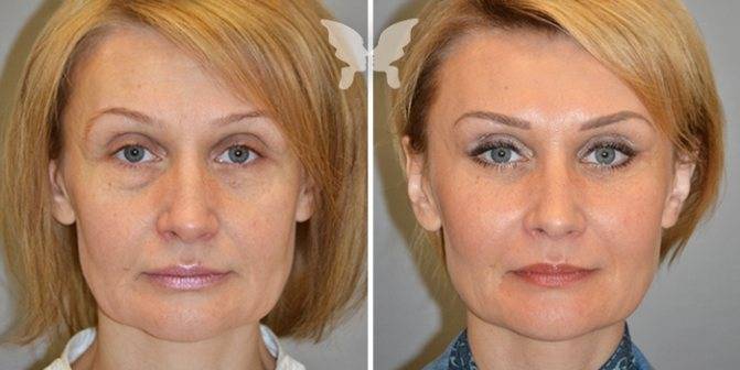 Эндоскопическая подтяжка лица - процедура, отзывы, фото и видео