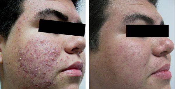 Полисорб: маска для лица от прыщей и черных точек, как сделать для очищения кожи – рецепт дерматолога и отзывы