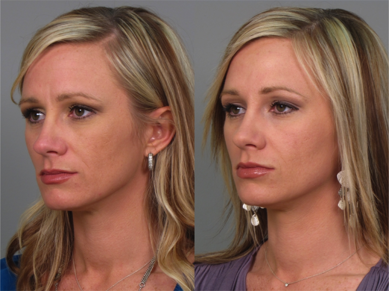 После укола ботокса в лоб. Ботокс до и после. Ботокс для лица до и после. Уколы ботокса до и после. Ботокс до и после фото.