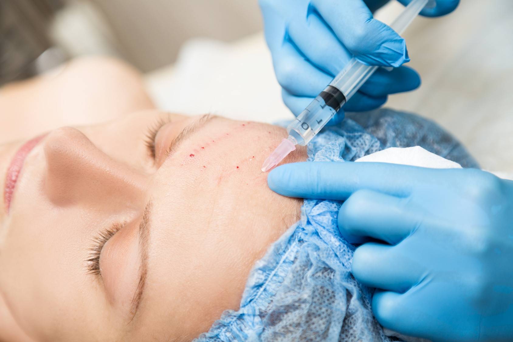 Мезотерапия – что это и какой у нее механизм действия?