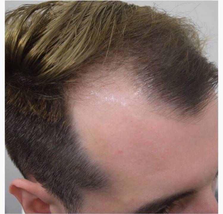 Почему выпадают волосы у мужчин, что с этим делать и как вернуть волосам густоту?