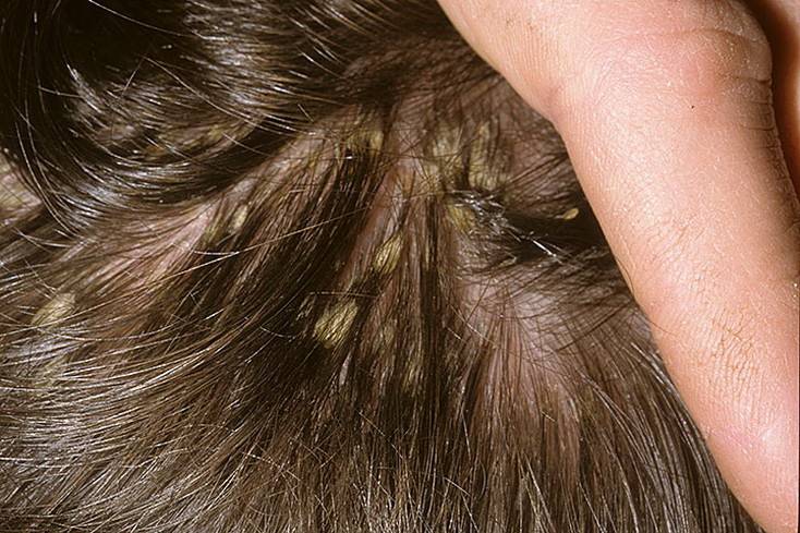 Себорейный псориаз: 8 фото, лечение, причины, симптомы и профилактика