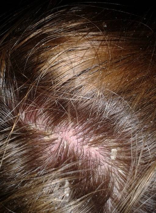 Почему шелушится, чешется кожа на голове: причины, методы лечения