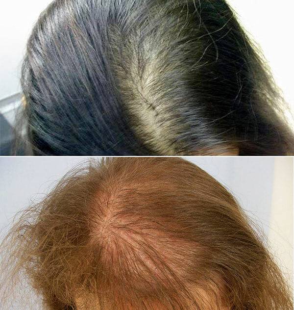 Причины выпадения волос у девушек: почему начали резко выпадать, основное лечение в 16, 17, 20 и 25 лет