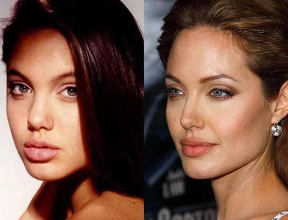 Анджелина джоли до пластики. Анджелина Джоли пластические операции. Анджелина Джоли ментопластика. Анджелина Джоли ринопластика. Анджелина Джоли до операции и после.
