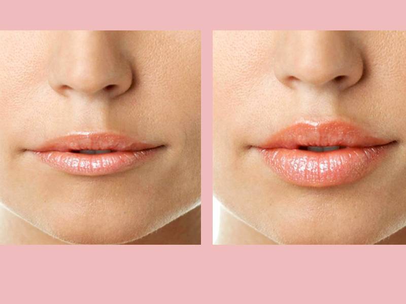 Увлажнение губ гиалуроновой кислотой без увеличения фото до и после