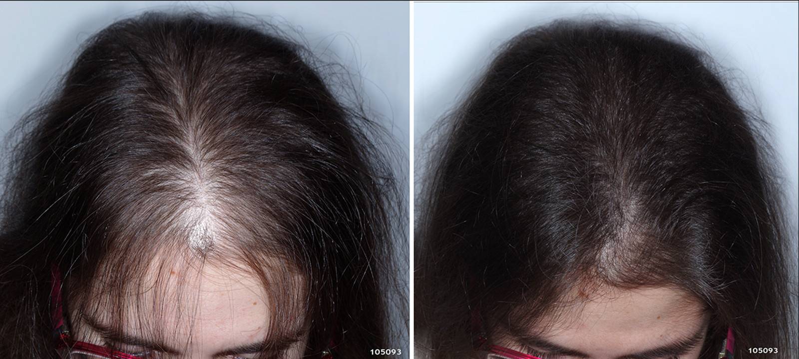 Потеря волос: как остановить сильную потерю волос и можно ли контролировать выпадение волос?