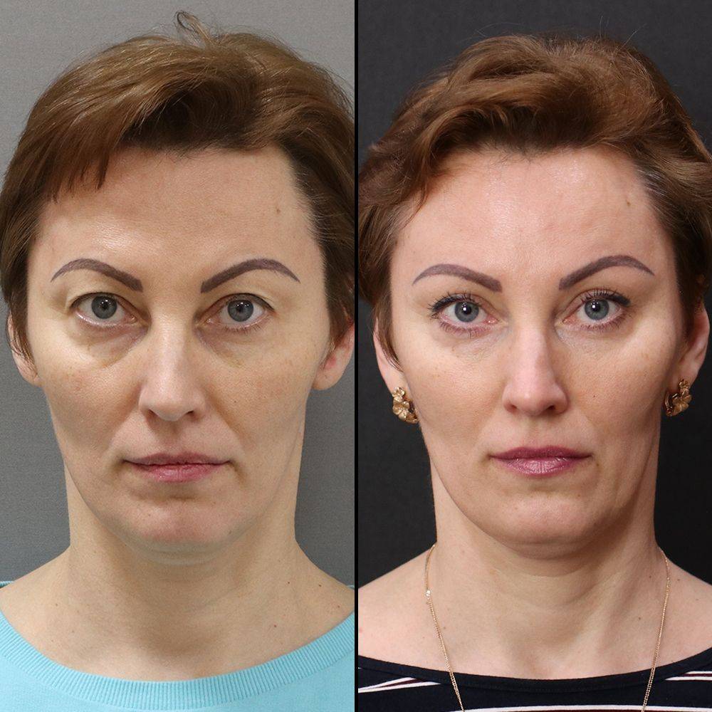 Rf лифтинг лица фото до и после