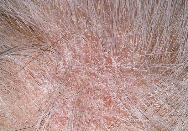 Шелушение кожи головы и сухость - причины и лечение с помощью шампуней и народных средств