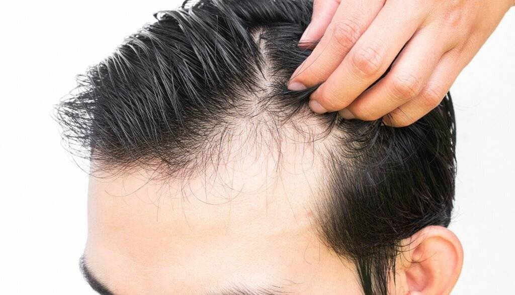 Выпадение волос - причины и лечение у мужчин