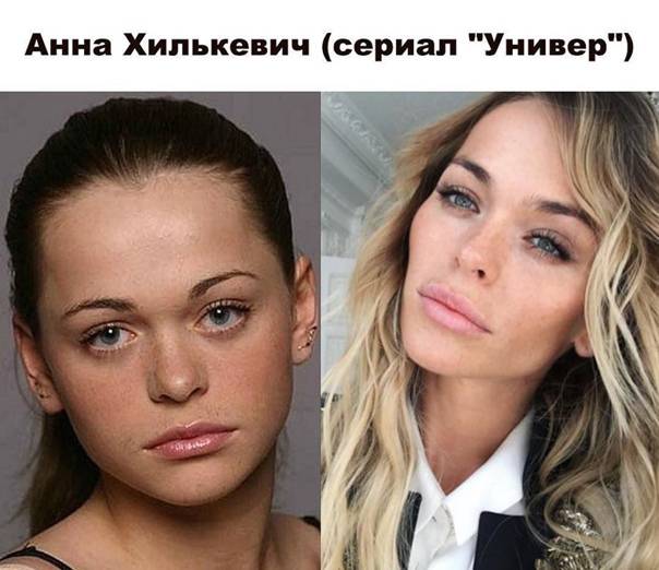 Российские звезды: топ-10 фото до и после пластики