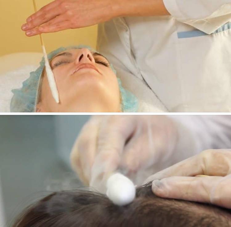 Криотерапия для волос