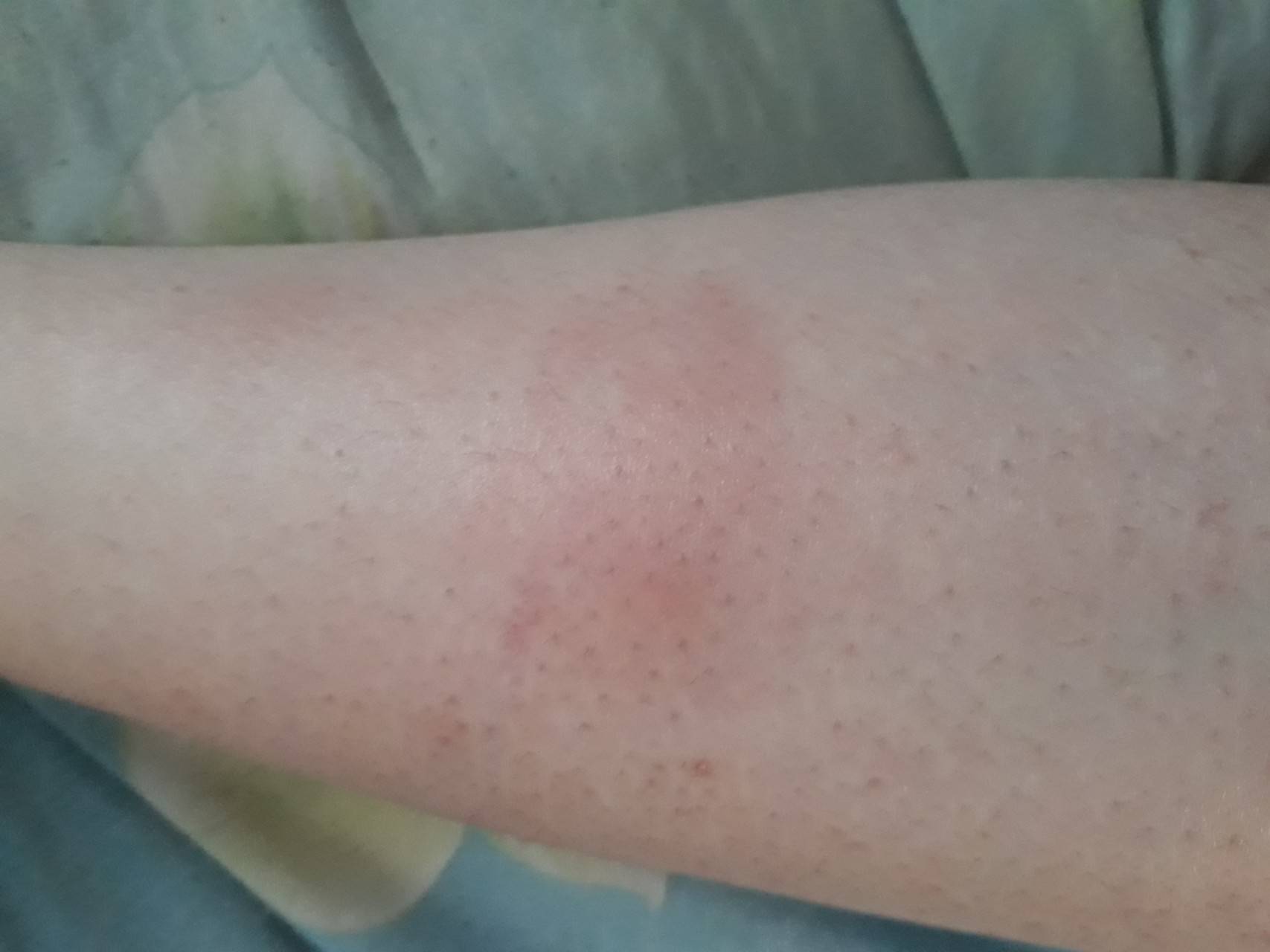 Красные пятна на теле: фото, возможные болезни, лечение