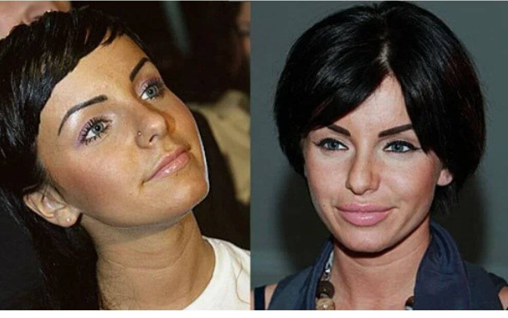 Неудачные пластические операции до и после фото обычных людей