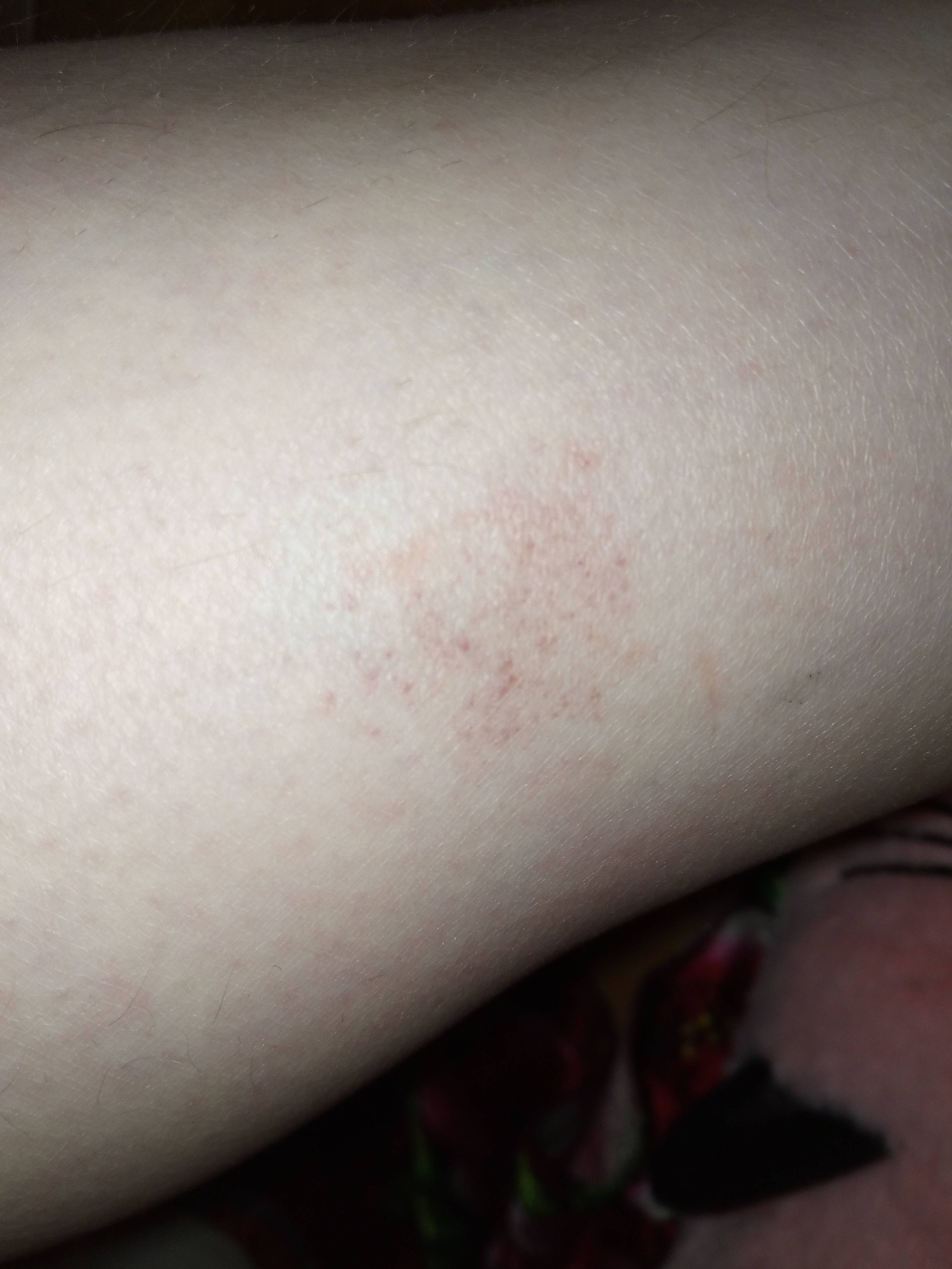 Красные пятна на теле у взрослого с фото: на шее, лице, руках и ногах