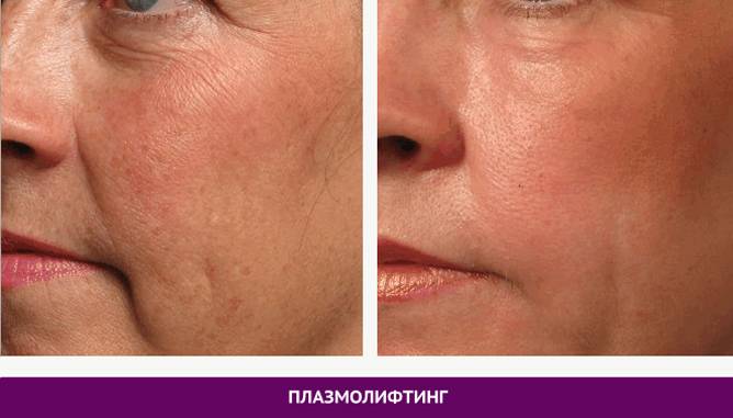 Отзывы о плазменном омоложении лица