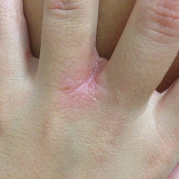 Шелушится кожа на пальцах рук: каковы симптомы и причины, а также почему иногда трескается и облезает только на кончиках, что делать и методы лечения