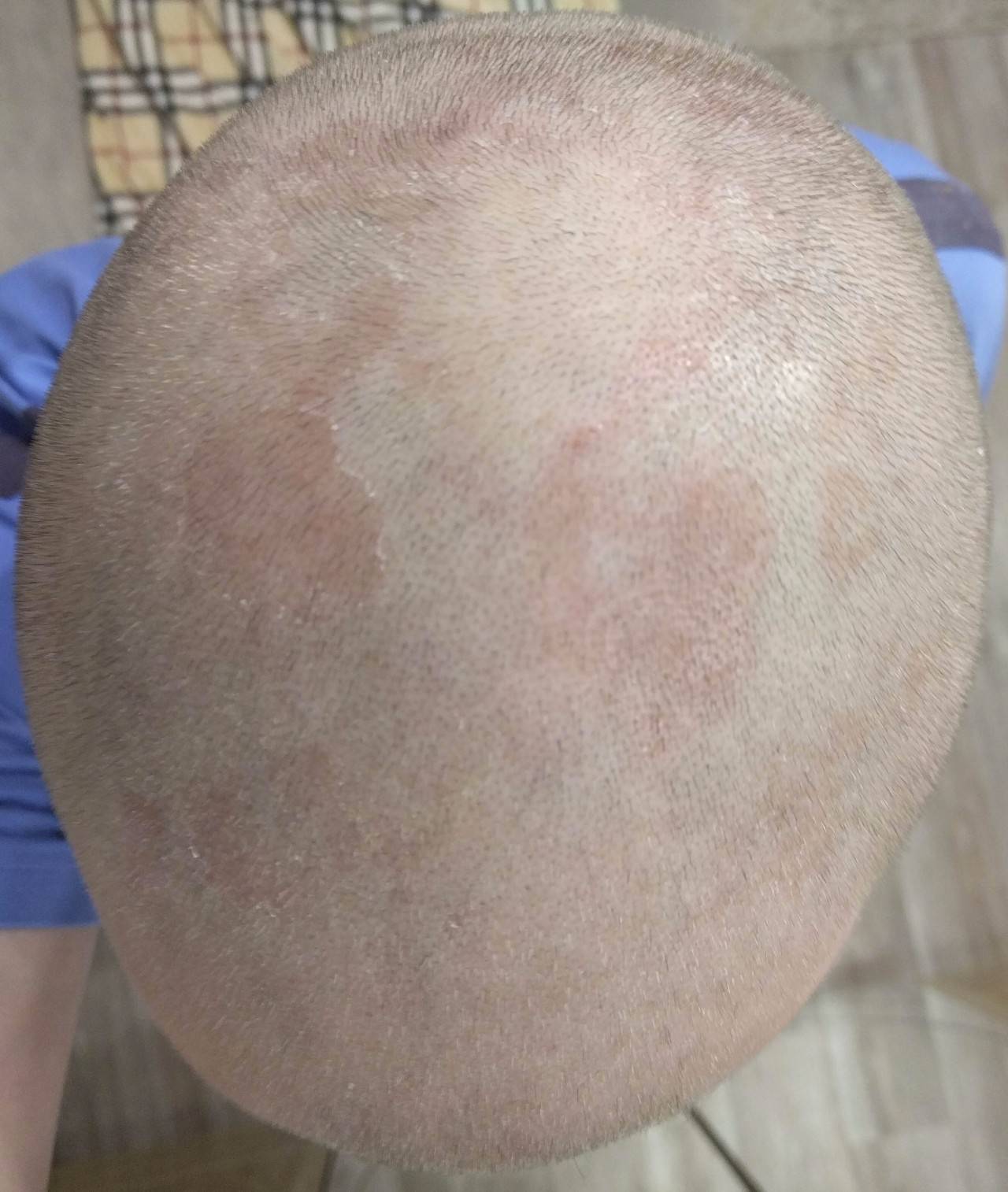 Почему возникают красные и коричневые пятна на голове? распространенные причины