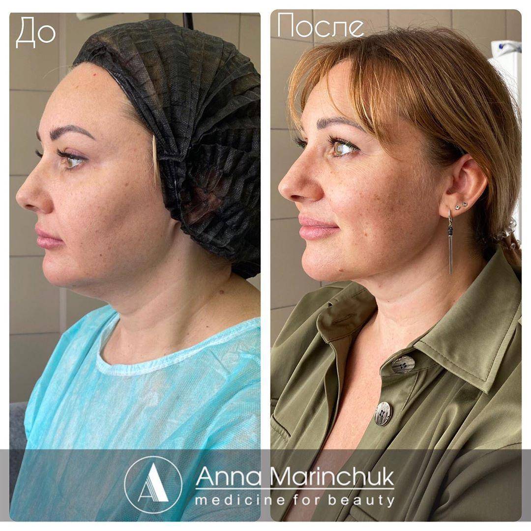 Лазерная липосакция подбородка