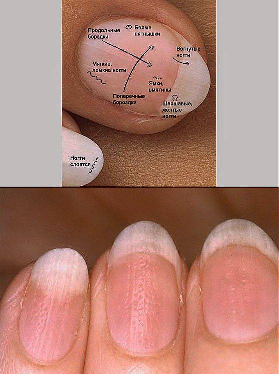 Определение болезни по ногтям