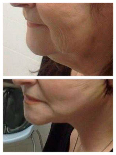 Ритидэктомия - современный помощник в борьбе за молодость и красоту